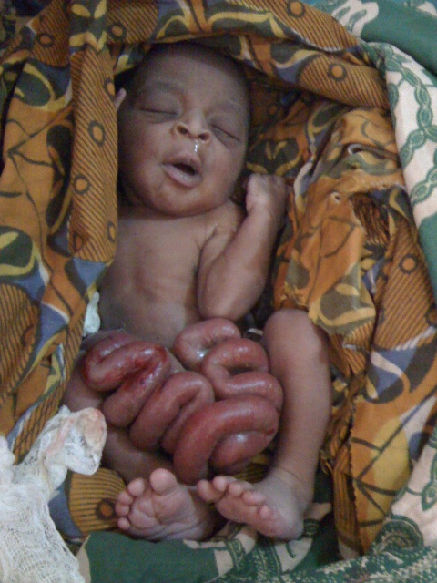 One day old baby with a gastroschisis, much of his intestines are outside his abdomen.  His family took him home to die.  