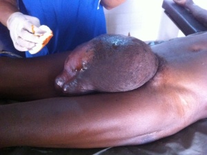 This was the giant hernia, with most of the small intestine in his scrotum.