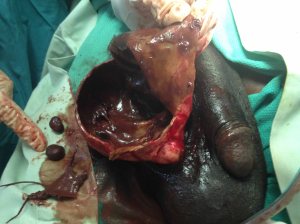 This man came in with what appeared to be bilateral  hydroceles.  The left side was just a hydrocele, but the right side had a dead testicle and old hematoma.  